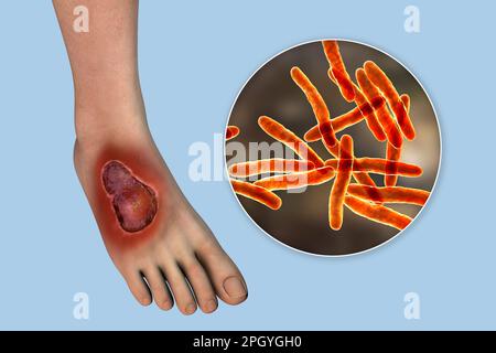 Buruli ulcer and Mycobacterium ulcerans, illustration Stock Photo