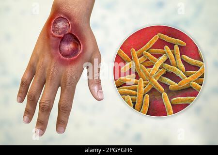 Buruli ulcer and Mycobacterium ulcerans, illustration Stock Photo