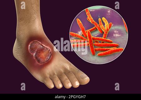 Buruli ulcer and Mycobacterium ulcerans, illustration Stock Photo