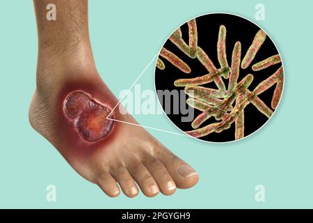 Buruli ulcer and Mycobacterium ulcerans, illustration Stock Photo