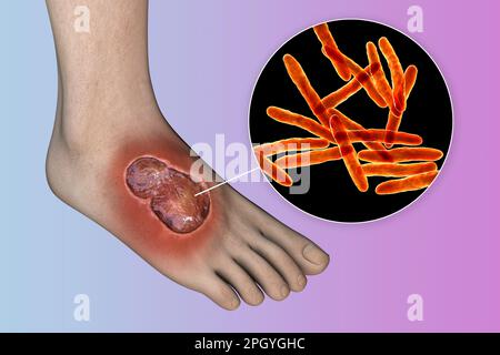 Buruli ulcer and Mycobacterium ulcerans, illustration Stock Photo