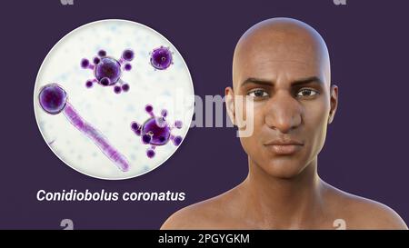 Rhinofacial conidiobolomycosis and fungus, illustration Stock Photo