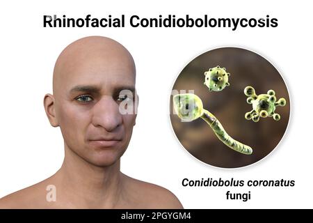 Rhinofacial conidiobolomycosis and fungus, illustration Stock Photo