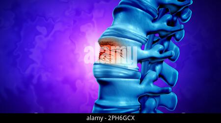 Traumatic Spine Fracture and vertebral injury medical concept as a human anatomy spinal column with a broken burst vertebra due to compression Stock Photo