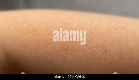 Skin mole closeup. Macro photo of blemish similar to melanoma, brown nevus, small birthmark, spot on human skin Stock Photo