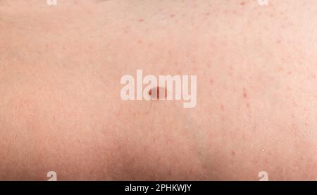 Skin mole closeup. Macro photo of blemish similar to melanoma, brown nevus, small birthmark, spot on human skin Stock Photo