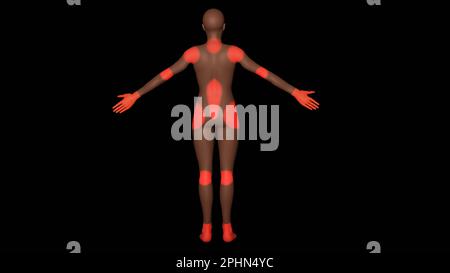 Human female body. Neuropathic pain zones in body. Peripheral Neuropathy. 3d rendering illustration. Stock Photo