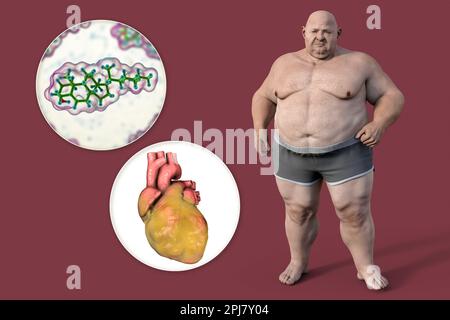 Cholesterol and fatty heart in overweight man, illustration Stock Photo