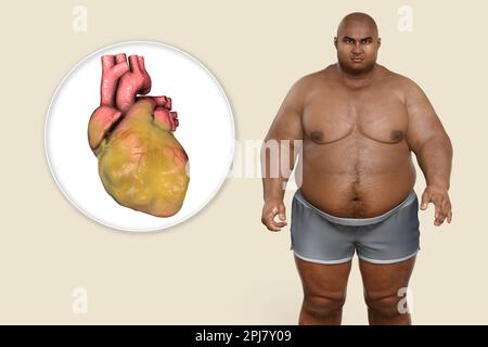 Fatty heart in overweight man, illustration. Stock Photo