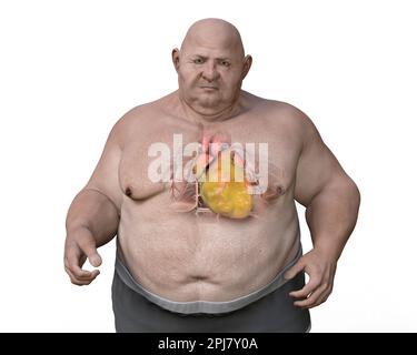 Fatty heart in overweight man, illustration. Stock Photo