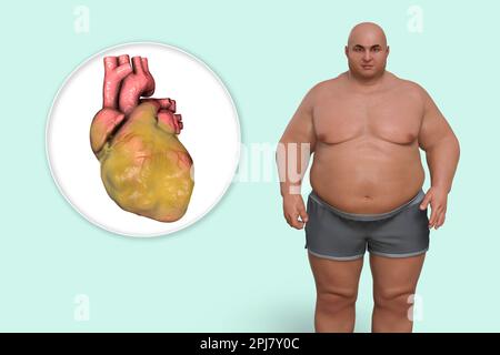 Fatty heart in overweight man, illustration. Stock Photo