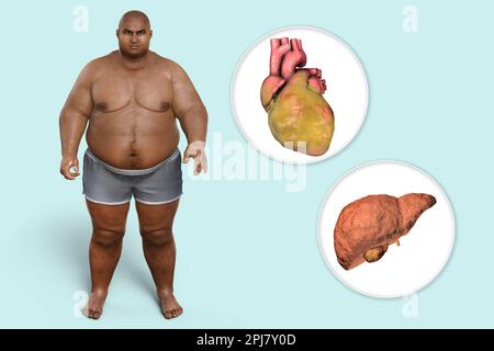 Fatty heart and liver in overweight man, illustration. Stock Photo