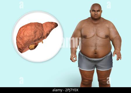 Fatty liver disease in an overweight man, illustration Stock Photo