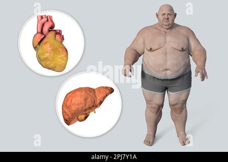 Fatty heart and liver in overweight man, illustration. Stock Photo