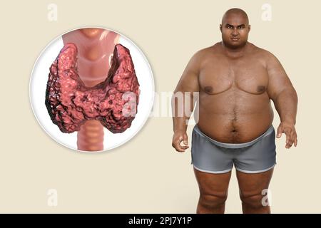 Thyroid diseases and obesity, conceptual illustration Stock Photo