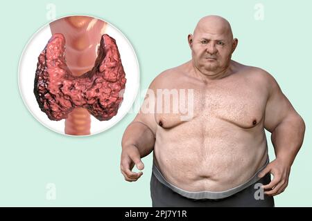 Thyroid diseases and obesity, conceptual illustration Stock Photo