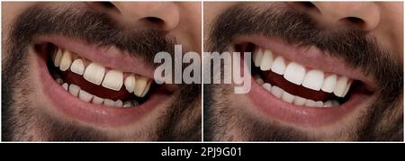 Collage with photos of young man before and after dental treatment ...