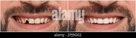 Collage with photos of young man before and after dental treatment ...