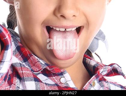 Little girl showing tongue with white patches, closeup. Oral candidiasis (thrush) disease Stock Photo