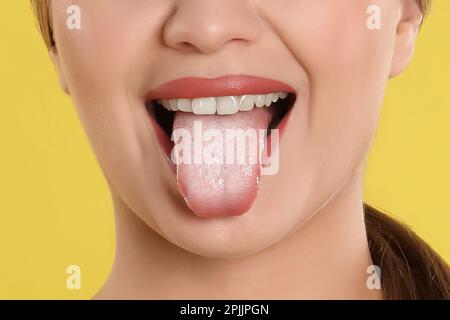 Young woman showing tongue with white patches on yellow background, closeup. Oral candidiasis (thrush) disease Stock Photo