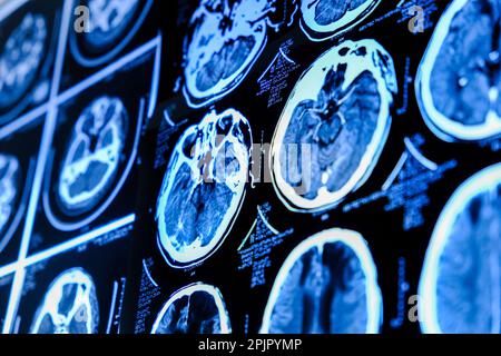 Magnetic resonance imaging of the brain close up. MRI Stock Photo - Alamy