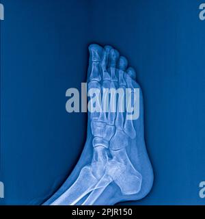 X-ray of foot on dark background, radiograph Stock Photo