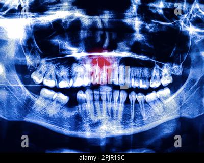 Panoramic dental X-Ray, two root canal treatments with red area Stock Photo