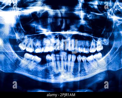 Panoramic dental tooth X-ray. Radiography for dental structures research concept. Stock Photo