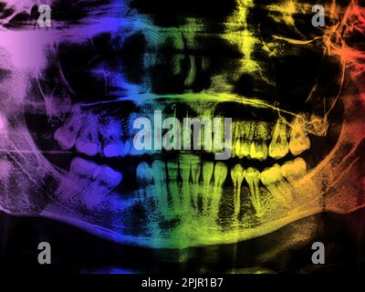 X-ray teeth mandible human skull. Panoramic negative photo facial image of mouth young adult female. Picture was taken on digital system equipment for Stock Photo