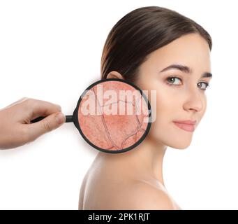 Young woman with facial dry skin problem on white background Stock Photo