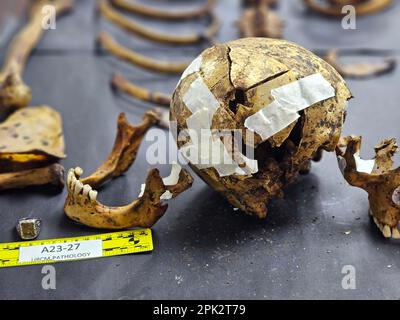 Manila, Philippines. 04th Apr, 2023. Forensic pathologist Dr. Raquel Fortun examines the exhumed skeletons of drug war victims in Caloocan City, in Metropolitan Manila, Philippines, on April 4, 2023. (Photo by Sherbien Dacalanio/Pacific Press/Sipa USA) Credit: Sipa USA/Alamy Live News Stock Photo