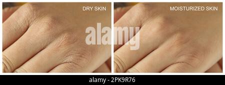 Collage with photos of person with dry and moisturized skin, closeup view of hand. Banner design Stock Photo