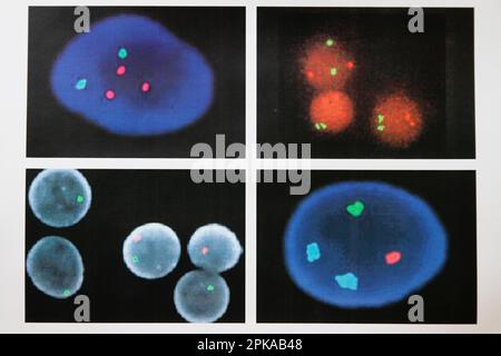 Cytogenetics laboratory, prenatal diagnosis by medical imaging FISH (Fluorescent In Situ Hybridization / Hybridization par Fluorescence In Situ). Stock Photo