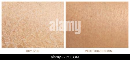 Collage with photos of dry and moisturized human skin, closeup. Banner design Stock Photo