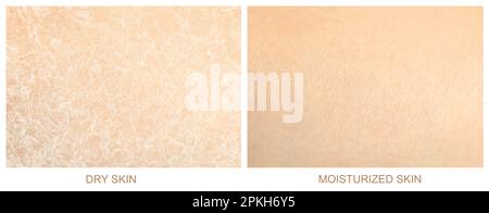 Collage with photos of dry and moisturized human skin, closeup. Banner design Stock Photo