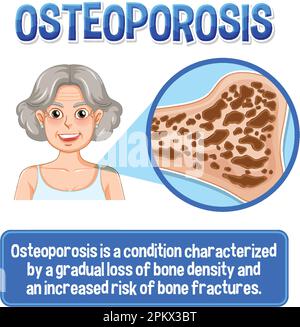 Informative poster of Osteoporosis human bone illustration Stock Vector