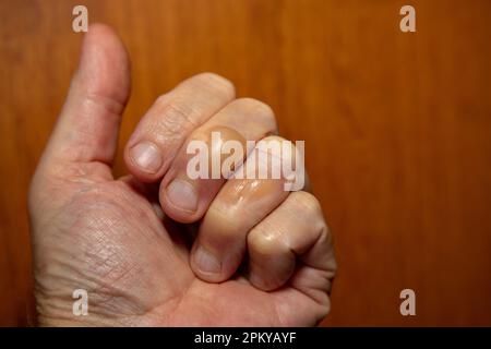 Typical skin blisters from second-degree boiling oil burns Stock Photo ...