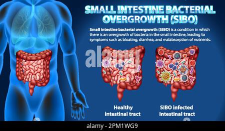 Small Intestine Bacterial Overgrowth (SIBO) Illustration Stock Vector ...