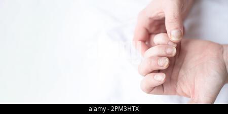 Male cut nails with nail fungus. Fungal infection on hands legs, finger with onychomycosis. Care and treatment. Closeup of a foot with damaged nails b Stock Photo