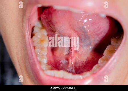 Close-up of the lower jaw, hard palate, soft palate, teeth and gums of a middle-aged woman. Stock Photo