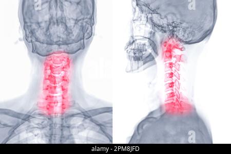 X-ray C-spine or x-ray image of Cervical spine AP and Lateral view for diagnostic intervertebral disc herniation ,Spondylosis and fracture. Stock Photo