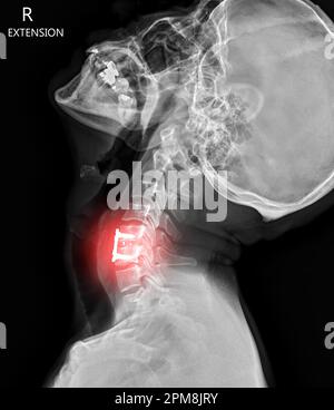 X-ray C-spine or x-ray image of Cervical spine lateral view showing fixed screw. Stock Photo