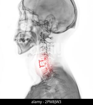 X-ray C-spine or x-ray image of Cervical spine lateral view showing fixed screw. Stock Photo