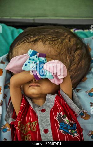 Hydrocephalus children, Semarang, Java, Indonesia, Asia Stock Photo