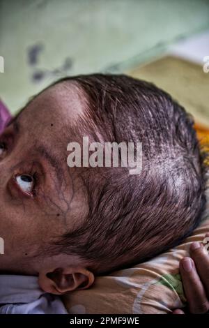 Hydrocephalus children, Semarang, Java, Indonesia, Asia Stock Photo