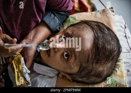 Hydrocephalus children, Semarang, Java, Indonesia, Asia Stock Photo