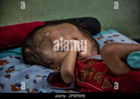 Hydrocephalus children, Semarang, Java, Indonesia, Asia Stock Photo