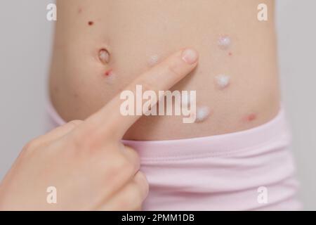 Child stomach infected with chickenpox is having treatment using white antiseptic foam Stock Photo