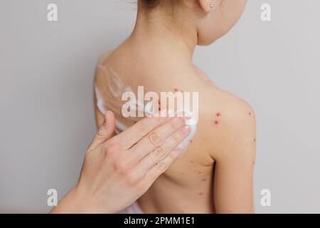 Child back infected with chickenpox is having treatment using antiseptic foam by hand Stock Photo