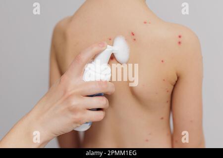 Child back infected with chickenpox is having treatment using antiseptic foam Stock Photo